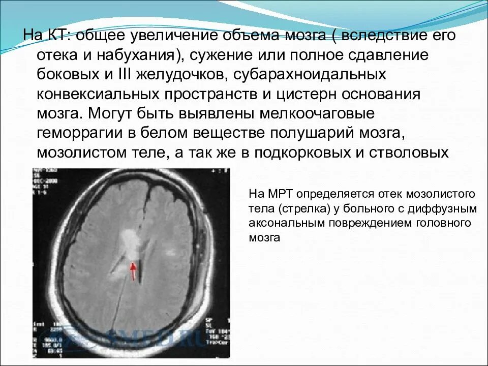 Оттек мозга