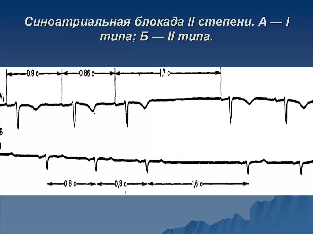 Блокада узла. Синоатриальная блокада Мобитц 1 ЭКГ. Синоатриальная блокада 2 степени 1 типа. Синоатриальная блокада 1 степени на ЭКГ. Са блокада 2 степени 1 типа на ЭКГ.