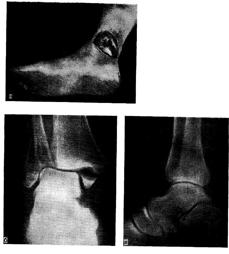 Перелом голеностопного сустава. Переломовывих голеностопного сустава рентген. Подвывих голеностопного сустава рентген. Перелом медиальной лодыжки рентген. Подвывих наружной лодыжки рентген.
