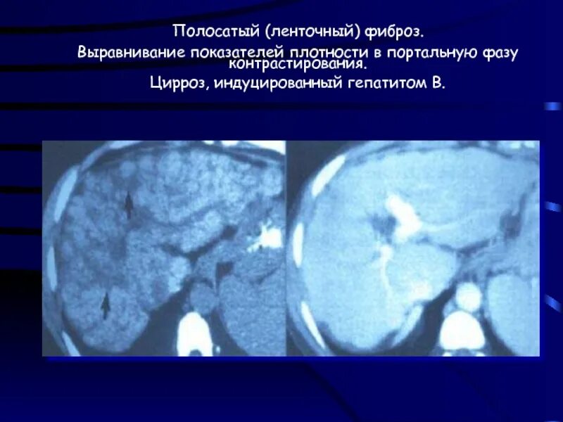 Билиарный цирроз печени кт. Кардиальный цирроз печени на кт.