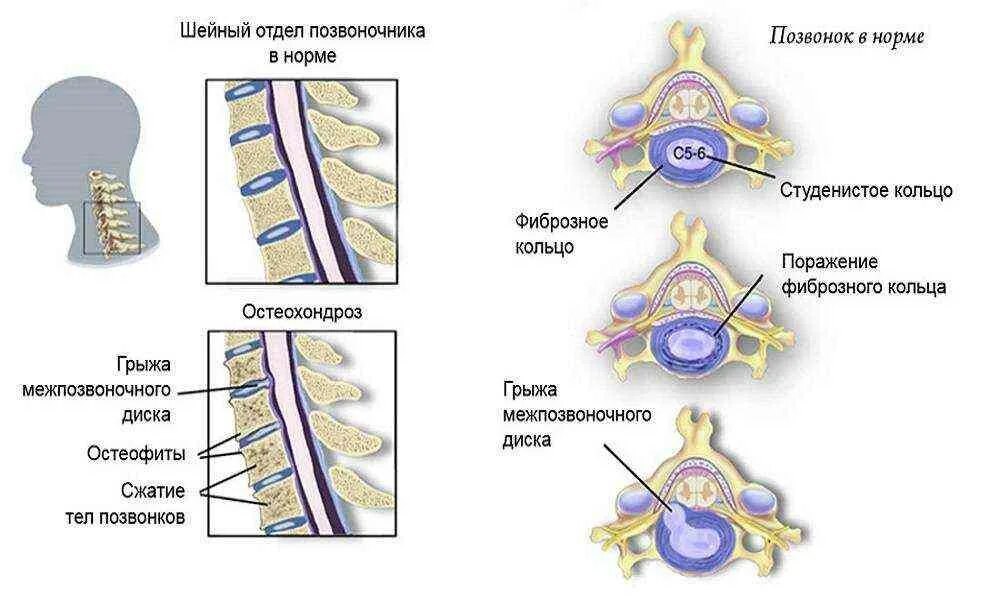 Хондроз шейного отдела позвоночника симптомы. Шейный отдел позвоночника шейный отдел позвоночника анатомия. Остеохондроз 1-2 позвонка шейного отдела позвоночника. Грыжа шейного отдела позвоночника. Шейный остеохондроз позвонки шейного отдела.