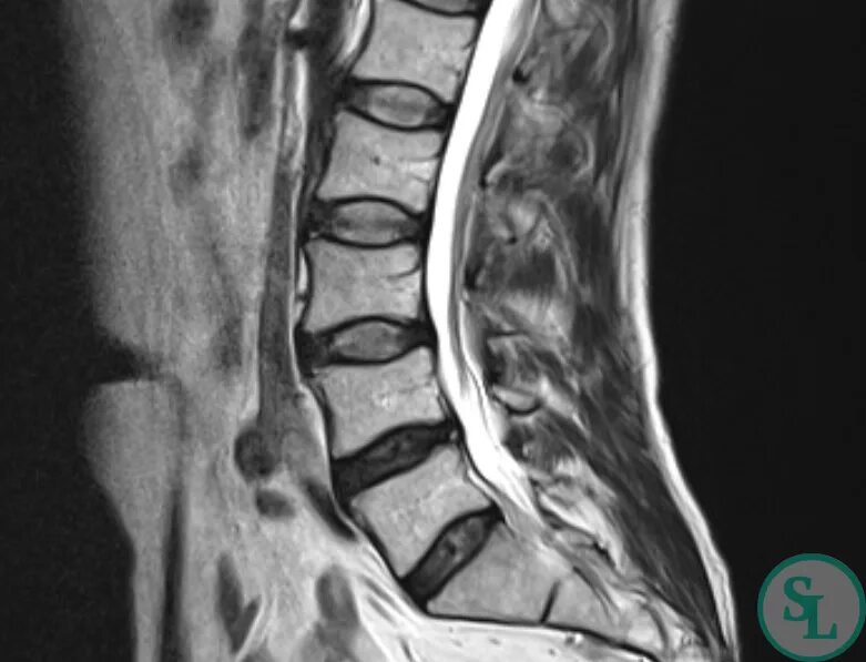 3 4 5 межпозвоночного диска. Циркулярно дорсальная протрузия диска l4-l5. Выбухание диска l4-l5. Циркулярная протрузия диска l1-l2. Циркулярная протрузия l5-s1.
