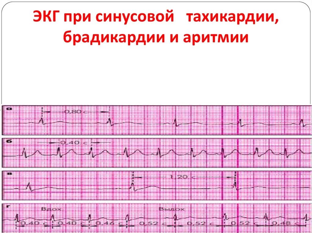 Аритмия и тахикардия. Синусовая тахикардия ЭКГ признаки. Желудочковая брадикардия на ЭКГ. ЭКГ синусовая тахикардия пленка. ЭКГ при синусовой тахикардии.