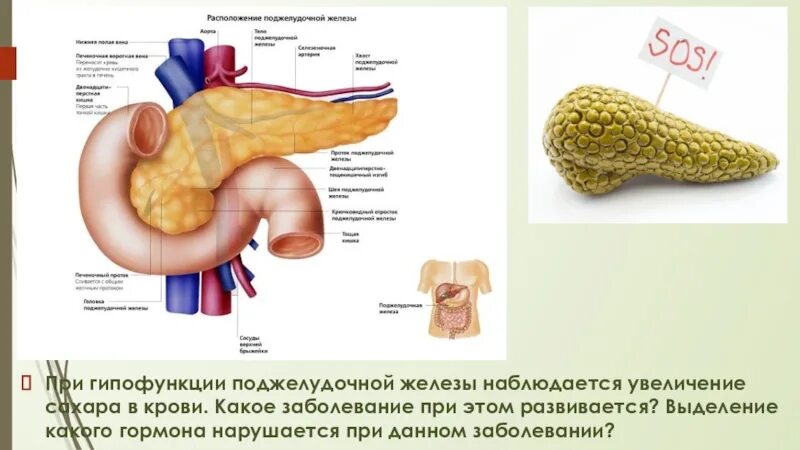 Гиперфункция поджелудочной железы. Гипофункция поджелудочной железы болезни. Заболевания при гипофункции поджелудочной железы. Гиперфункция поджелудочной железы болезнь. При гипофункции железы у человека развивается