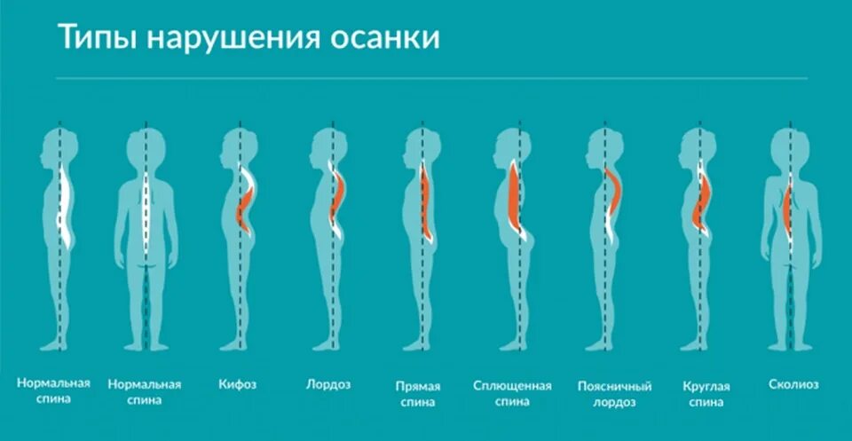 У ребенка в пояснице. Нарушение осанки. Нарушения осанки у детей. Виды нарушения осанки. Типы нарушения осанки у детей.