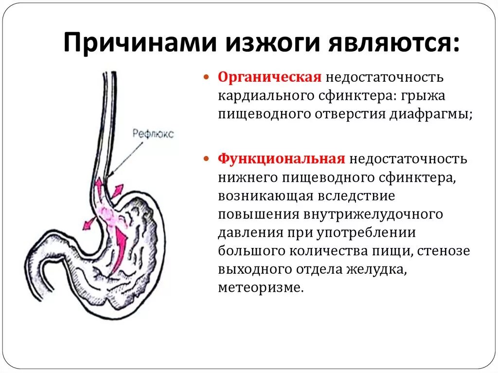 Изжога причины. Факторы возникновения изжоги. Кардиальный жом желудка. Несмыкание кардии желудка