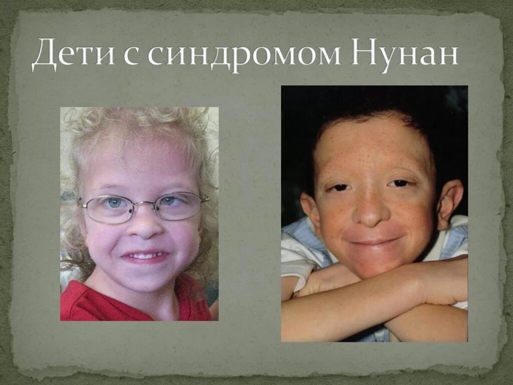 Что такое айси синдром у детей фото