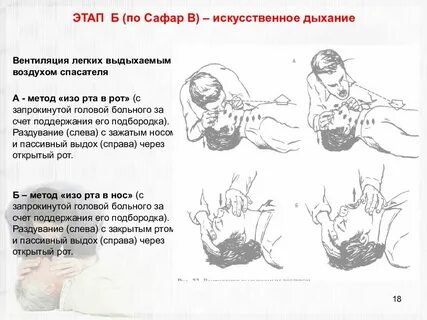 2 методы искусственной вентиляции легких