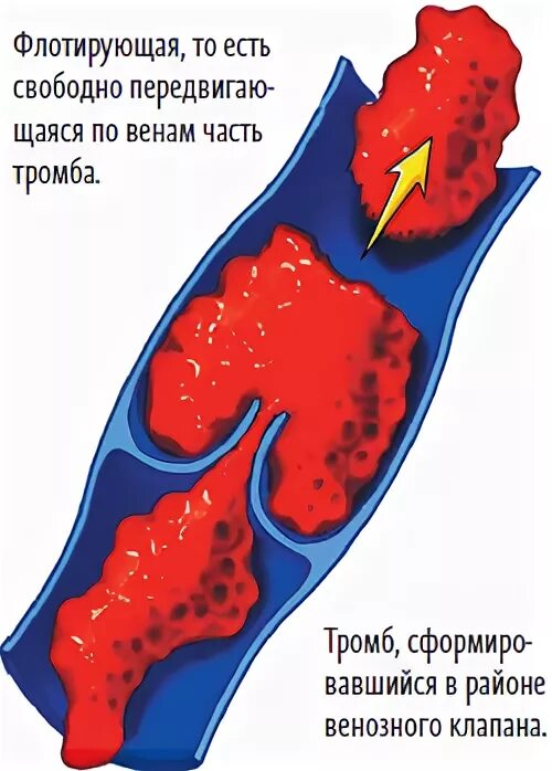 Части тромбов