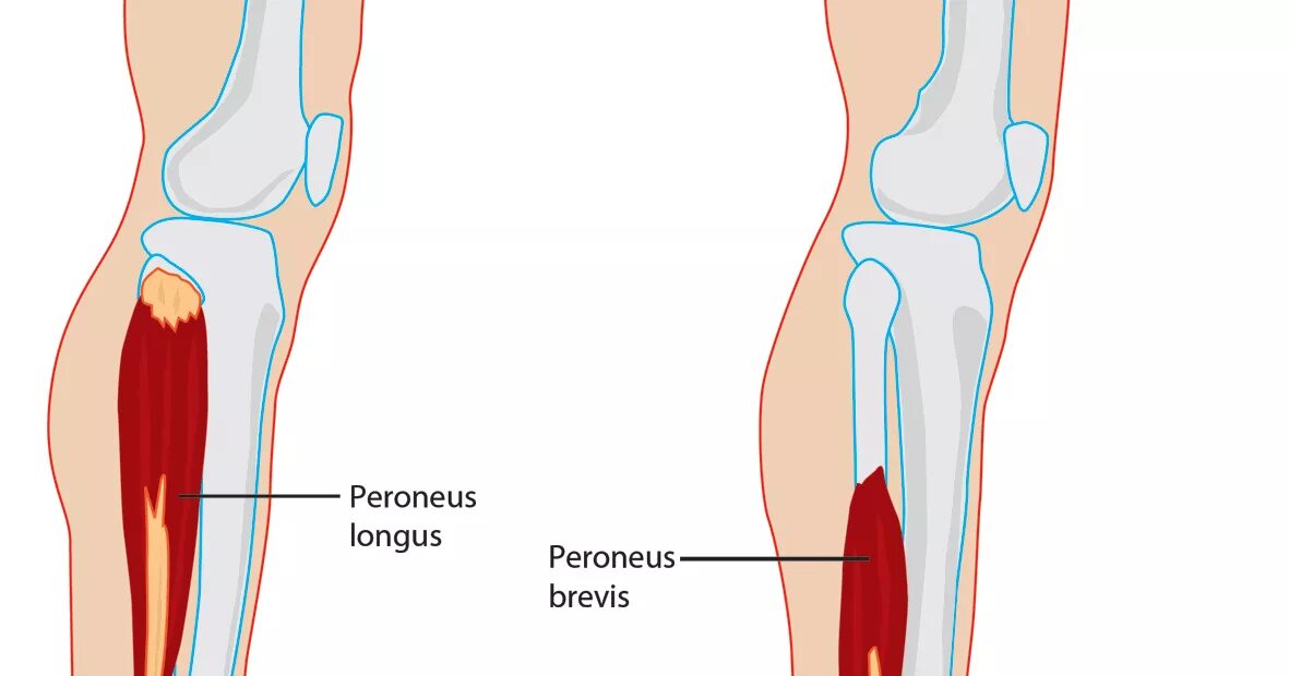 Перонеус Лонгус. Peroneus Tertius. Мускулюс Перонеус Лонгус. Атрофия икроножных мышц.