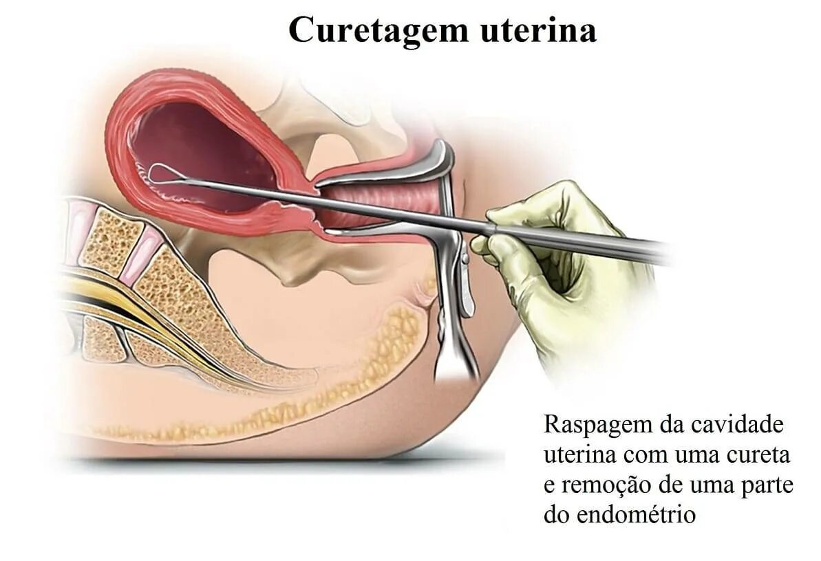 Как происходит выскабливание. Раздельное диагностическое выскабливание слизистой оболочки матки. Вакуумное выскабливание полости матки. Вакуум-аспирация полости матки. Вакуум аспирация аборт.