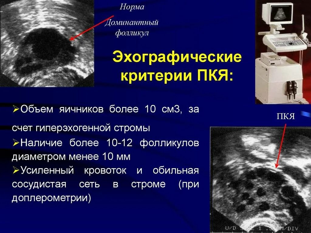 Синдром поликистозных яичников УЗИ. УЗИ критерии Гиперстимуляция яичников. Фолликулы 6 мм