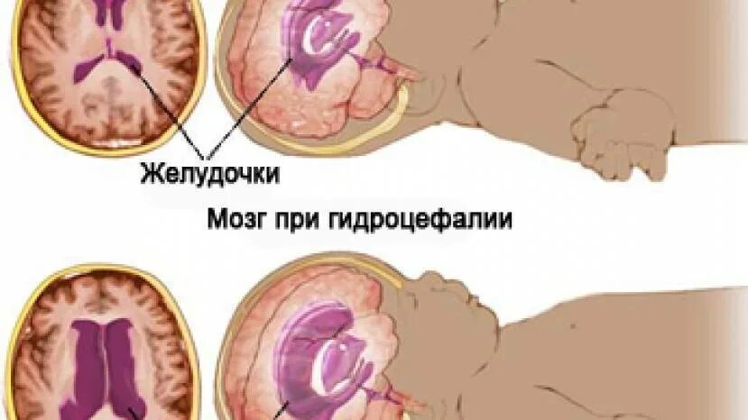 Декомпенсированная гидроцефалия. Гидроцефалия головного мозга. Гидроцефалия головного мозга у новорожденных. Гидроцефалия головного мозга у плода. Расширение желудочков у новорожденного