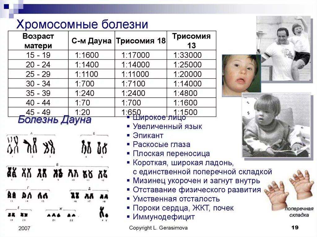 4 хромосома заболевание. Синдром Дауна хромосомная патология. Распространенность синдрома Дауна. Болезнь Дауна трисомия. Хромосомные болезни хромосомы.
