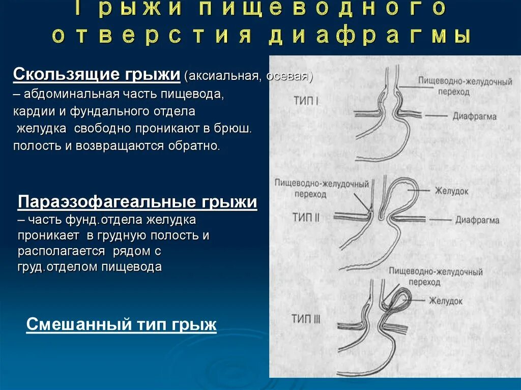 Скользящая грыжа под