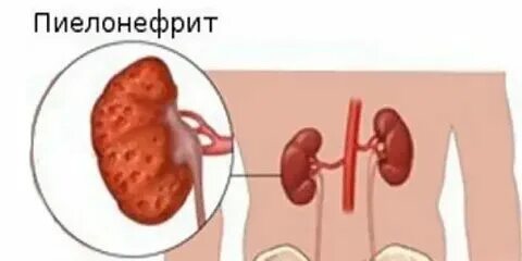 Пиелонефрит можно ли рожать. Пиелонефрит можно ли рожать