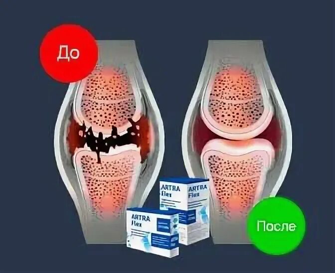 Артрафлекс. Артрафлекс