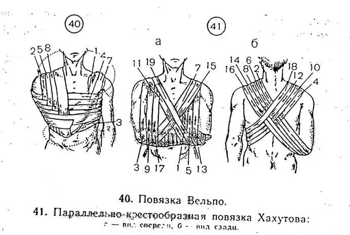 Схема наложения повязки Вельпо. Перевязка Вельпо. Повязка Вельпо алгоритм наложения. Наложите повязки «Дезо» и «Вельпо».