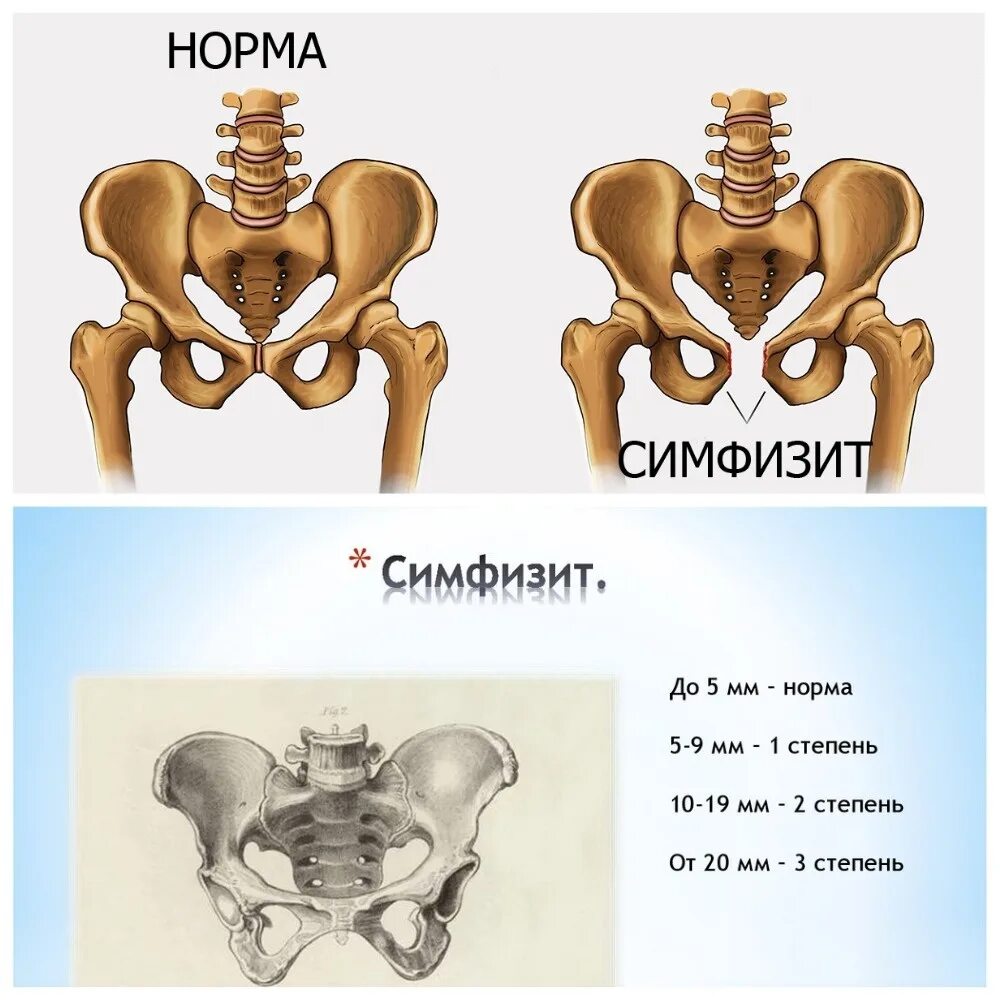 Кесарево при симфизите. Симфизите. Симфизит 2 степени. Операция при симфизите. Симфиз лобковой кости.