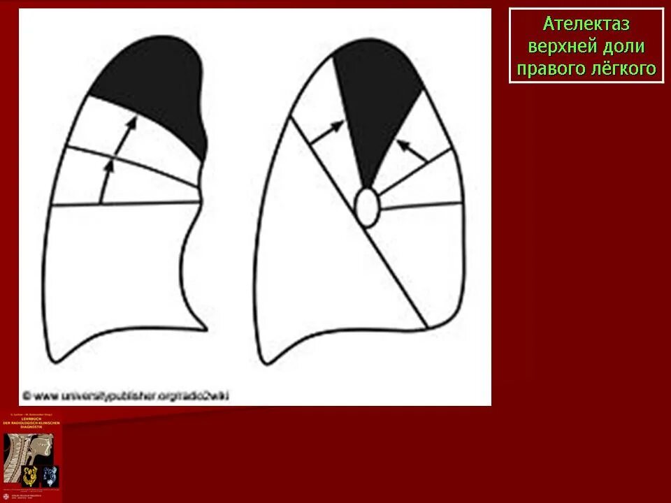 Ателектаз средней доли правого. Ателектаз верхней доли правого легкого на рентгене. Ателектаз верхней доли правого легкого схема. Ателектазы сегментов легких. Ателектаз левой доли легкого