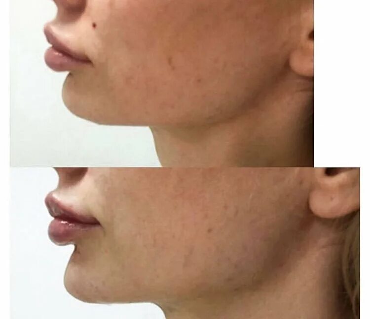 исправление подбородка филлерами. линия подбородка.