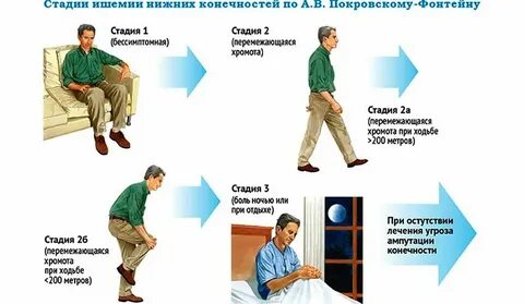 Ишемическая конечность