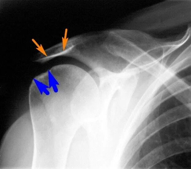 Разрыв плечевого сустава симптомы. Субакромиальный бурсит плечевого сустава рентген. Импиджмент синдром плечевого сустава рентген. Бурсит плечевого сустава рентген. Субакромиальный импинджмент рентген.