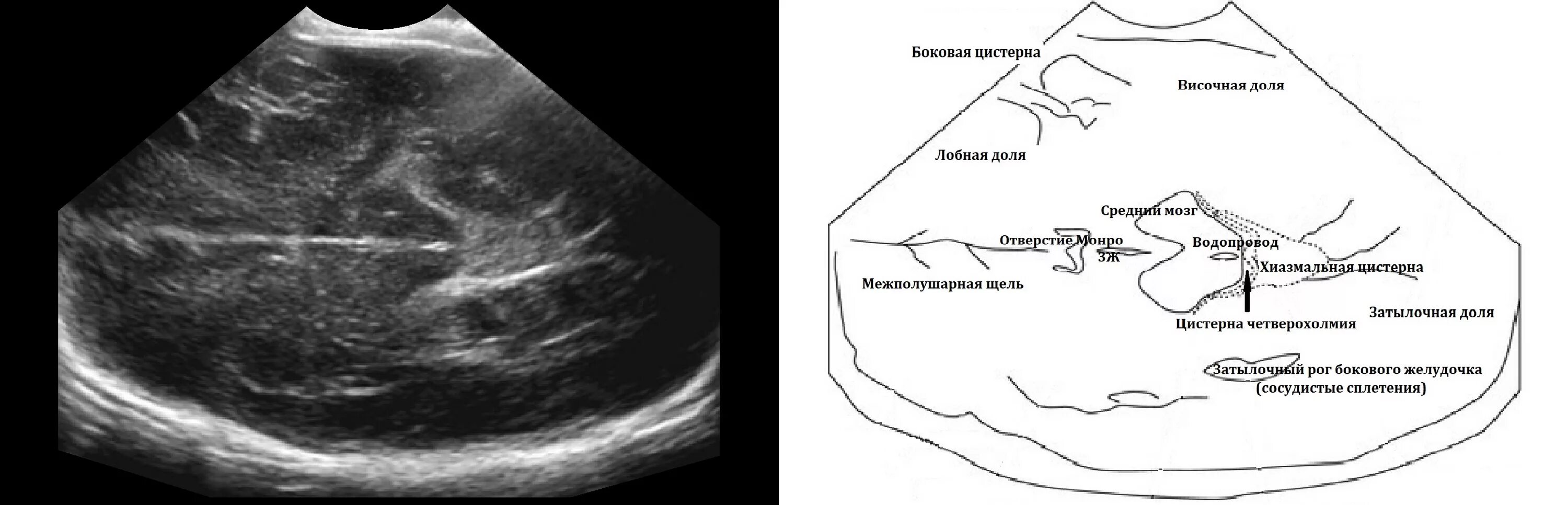 У плода киста мозга сплетения. УЗИ нейросонография новорожденных. НСГ срезы УЗИ. Срезы головного мозга плода на УЗИ. Анатомия головного мозга плода на УЗИ.