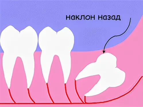 зачем нужен мудрый зуб. сколько зуб мудрости у человека может вырасти. сколько зуб мудрости у человека может вырасти. строение зубов мудрости. сколько зуб мудрости у человека может вырасти.