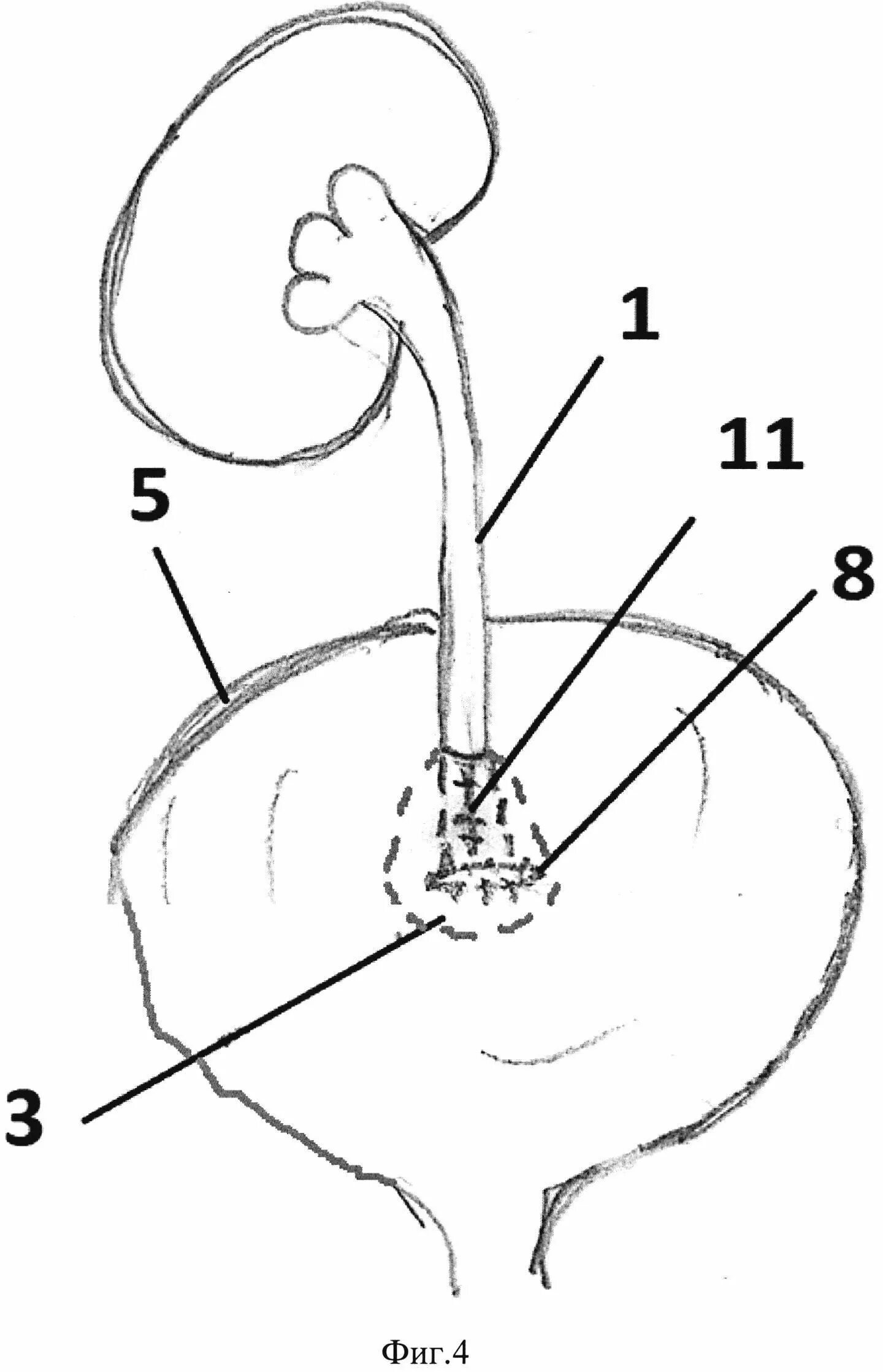 3 части мочеточника. Юкставезикальный отдел мочеточника кт. Сужения мочеточника анатомия. Отделы мочеточника схема. Юкставезикальный сегмент мочеточника.