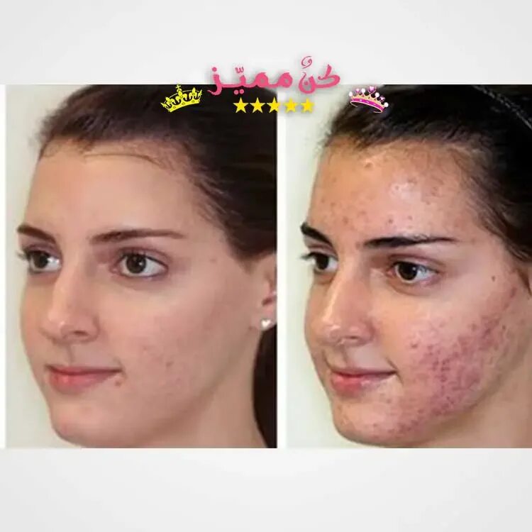 Как пользоваться дарсонвалем для лица от прыщей. Как пользоваться дарсонвалем для лица от прыщей. Расческа для роста волос дарсонваль. Дарсонваль от прыщей на лице и постакне. Как пользоваться дарсонвалем для лица от прыщей.