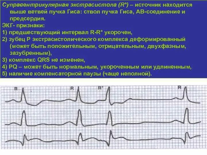 Единичные суправентрикулярные экстрасистолы. Суправентрикулярная экстрасистолия экг критерии. Наджелудочковая экстрасистолия на экг. Желудочковые экстрасистолы на экг. Наджелудочковая экстрасистолия на экг.