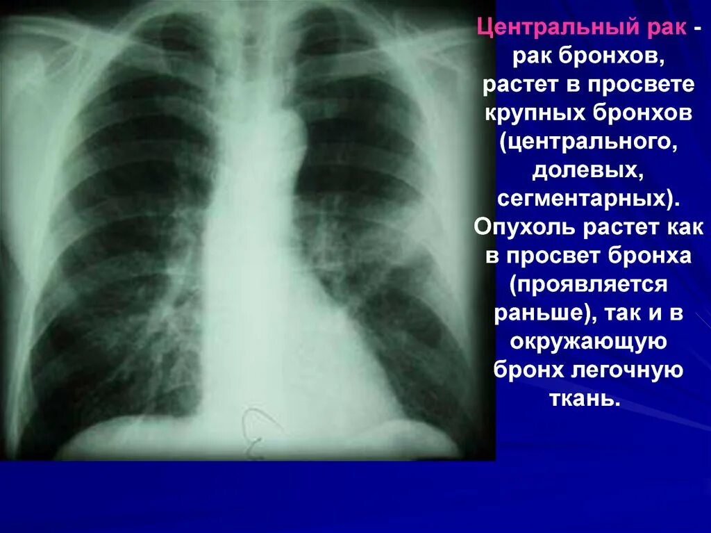 Стадии рака бронха. Бронхогенная карцинома рентген. Новообразования бронхов.