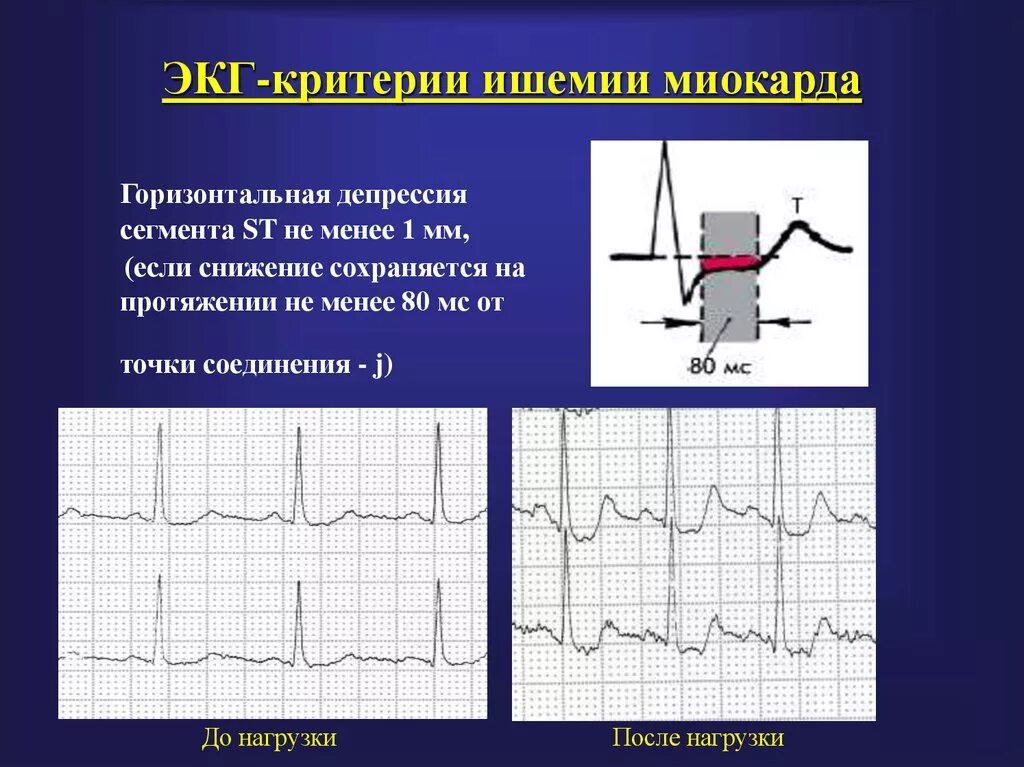 St ишемия