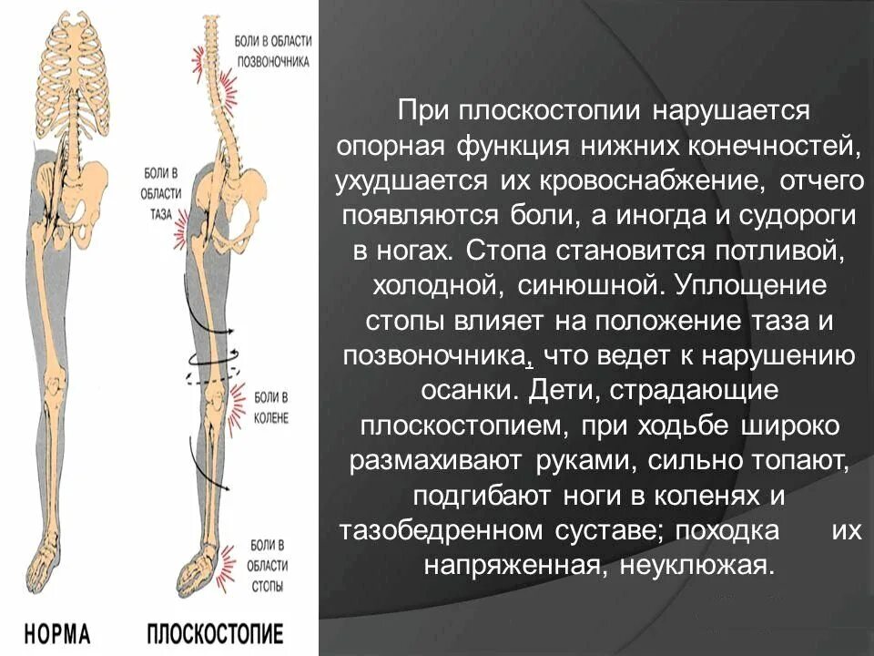 Опорная функция стопы. Плоскостопие нагрузка на позвоночник. Влияние плоскостопия на позвоночник. Нарушение функций нижних конечностей.