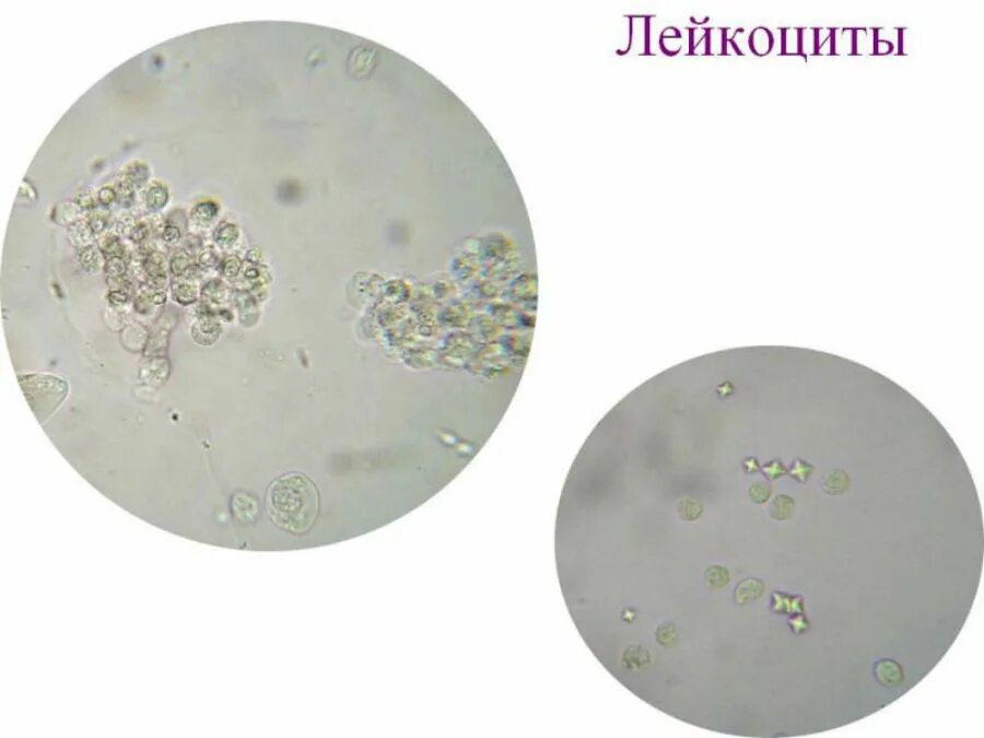 Нейтрофилы в мокроте. Лейкоциты в крови микроскопия. Микроскопия осадка мочи лейкоциты. Микроскопия осадка мочи лейкоциты. Исследование мочи микроскопия осадка нормы.