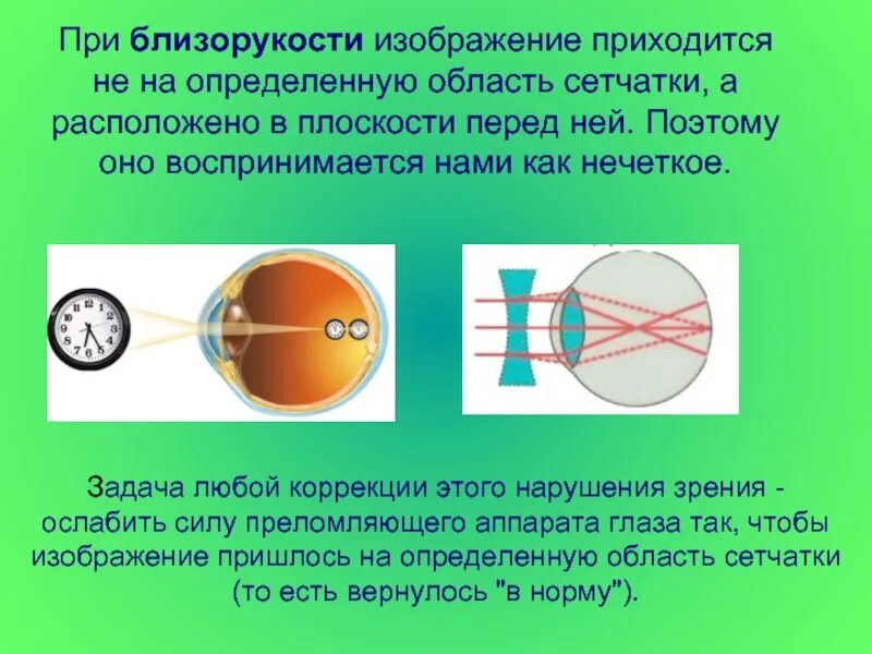 Изображения при миопии. Близорукость. Зрение при близорукости. Изображение при близорукости. Перед сетчаткой расположена