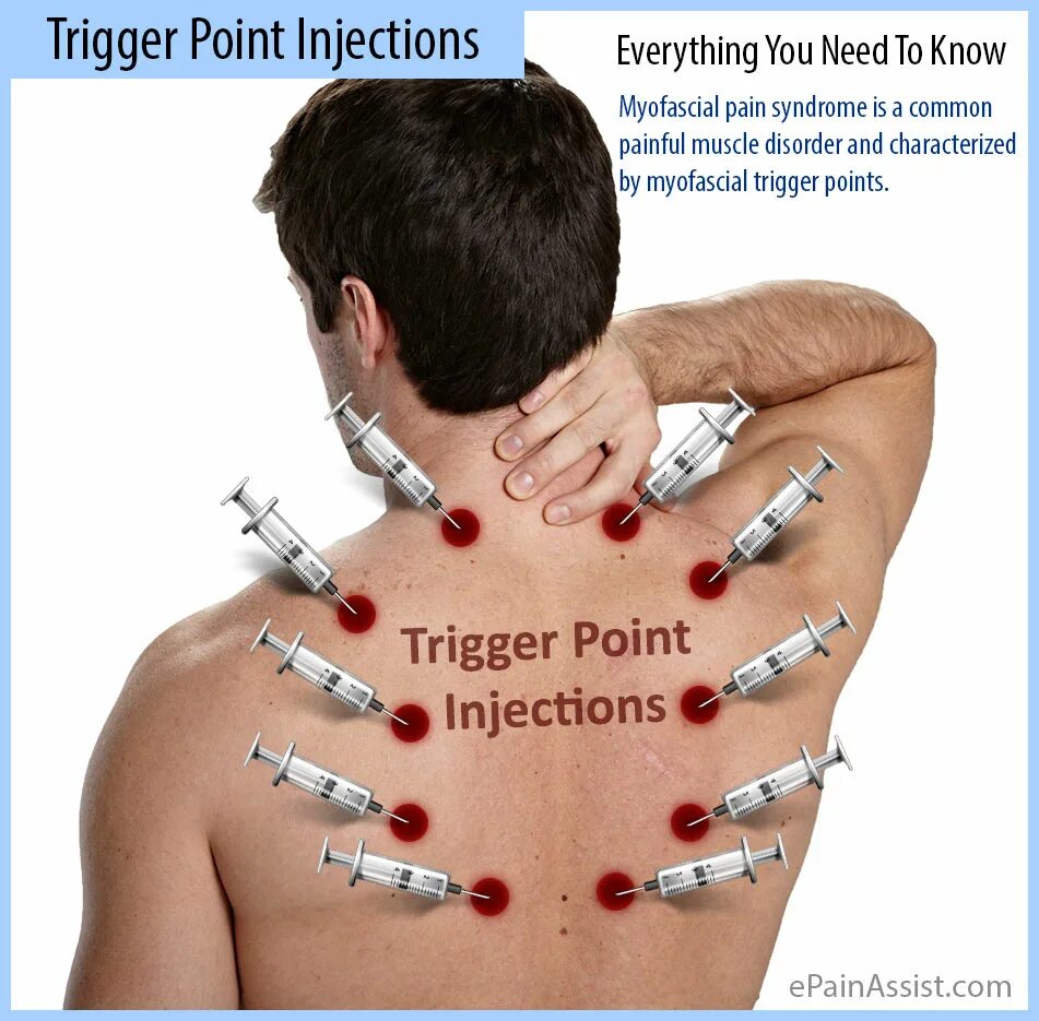 Точка колоть. Триггерные точки. Точки триггеры на спине. Триггер точка на теле. Расположение триггерных точек на спине.