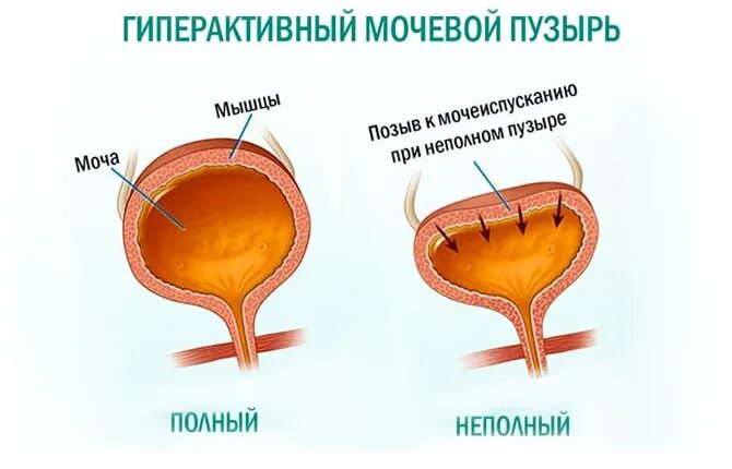 Гиппер активный мочевой пузырь. Гипоактивныймочевой пузырь. Гиперреактиврый мочевой пцзырь. Гиппер Актив мочевой пузыр. Операция шейки мочевого пузыря