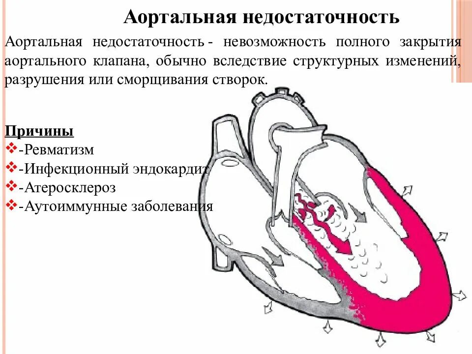 Сердечная недостаточность митрального клапана. Недостаточность аортального клапана порок сердца. Недостаточность аортального клапана гемодинамика схема. Гемодинамика при пороках сердца схема. Митральная недостаточность гемодинамика схема.