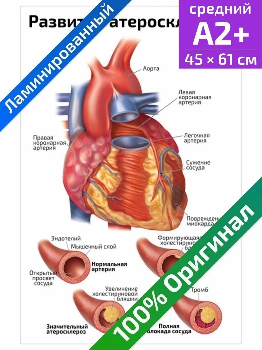 Атеросклероз медицинская помощь. Медицинские плакаты. плакат развитие атеросклероза.