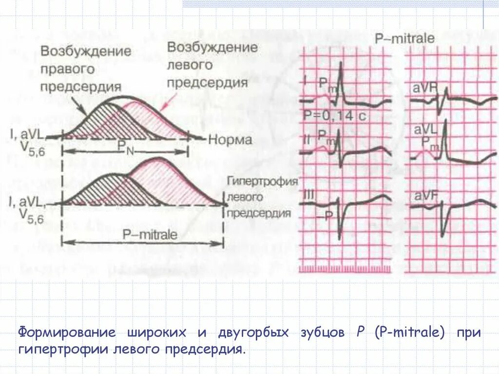 Двугорбый зубец на ЭКГ. Гипертрофия левого предсердия на ЭКГ. Формирование зубца p ЭКГ. ЭКГ показатели гипертрофии левого предсердия. Норма правого предсердия