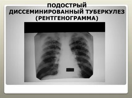 Диссеминированный кавернозный туберкулез