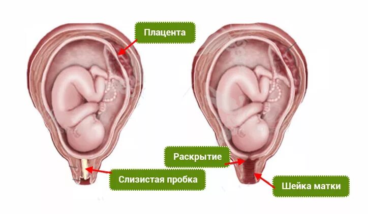 Где находится роды. Слизистая пробка при родах. Отошла пробка при родах. Отхождение слизистой пробки.