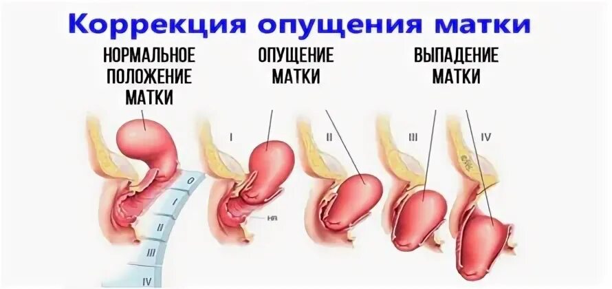 Опущение таки. Неполное выпадение матки. Опущение матки после 60 лет