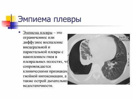 Эмпиема легкого