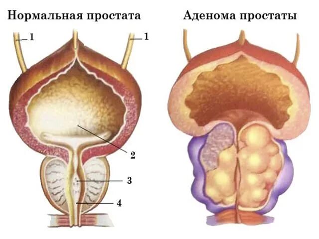 Доброкачественной гиперплазией предстательной железы у мужчин. Гиперплазия предстательной железы. Аденома предстательной железы и ДГПЖ. Анатомия аденомы предстательной железы.