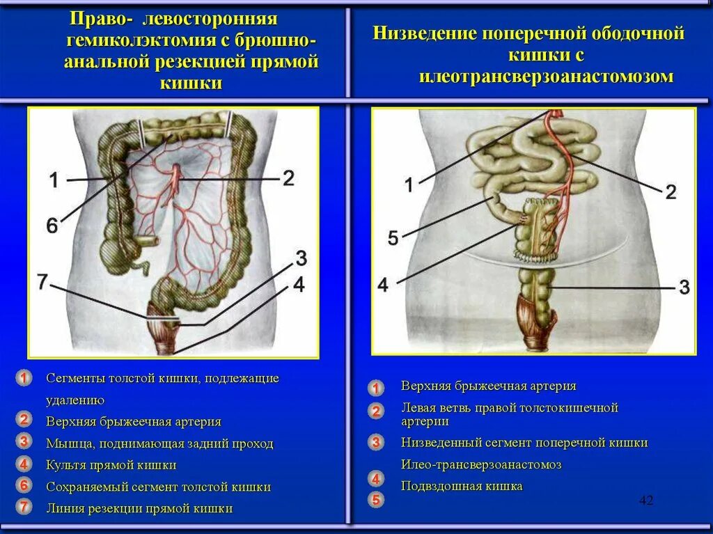 Левосторонняя гемиколо. Резекция поперечно ободочной кишки. Гемиколэктомия ободочной кишки. Илеотрансверзоанастомоз.