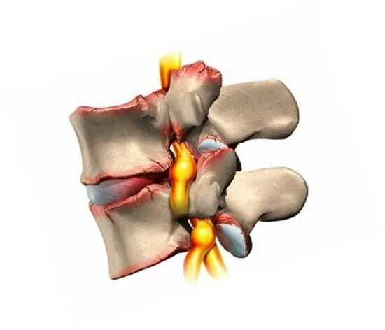 Грыжа Шморля l2 позвонка что это. Грыжа Шморля рентген. Грыжа Шморля поясничного отдела позвоночника что это. Грыжи Шморля остеохондроз. Несдавленный