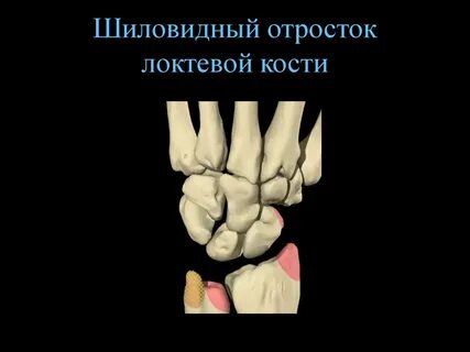Перелом шиловидного отростка правой